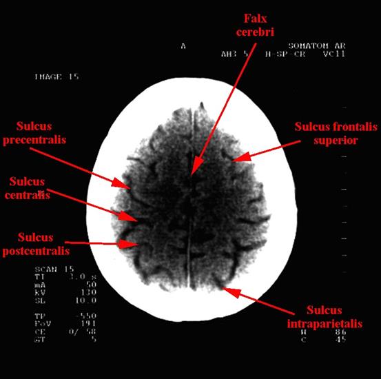 tomografia komputerowa głowy - 14a.jpg
